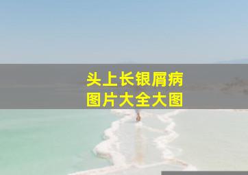 头上长银屑病图片大全大图